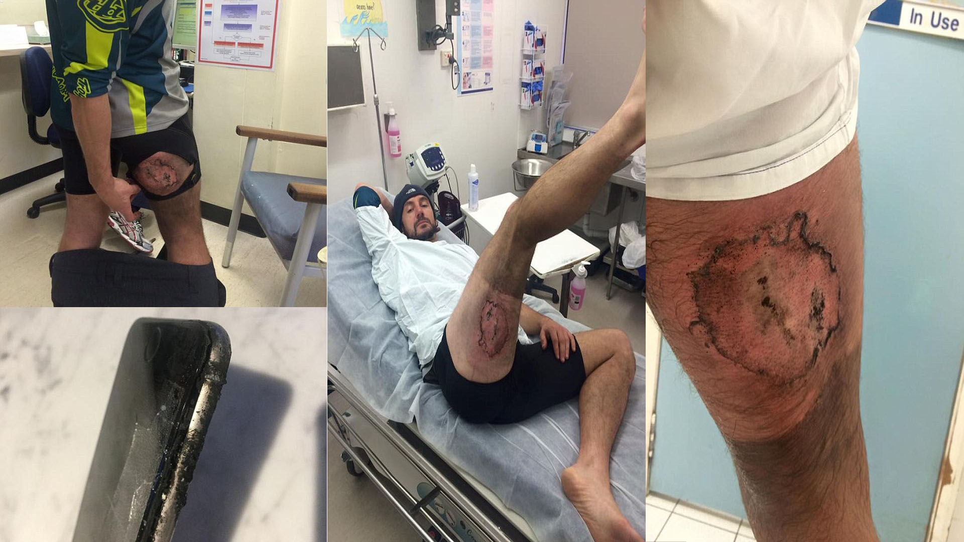 Harmadfokú égési sérülést okozott egy iPhone